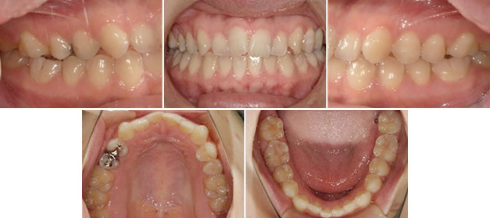 初診時の口腔内